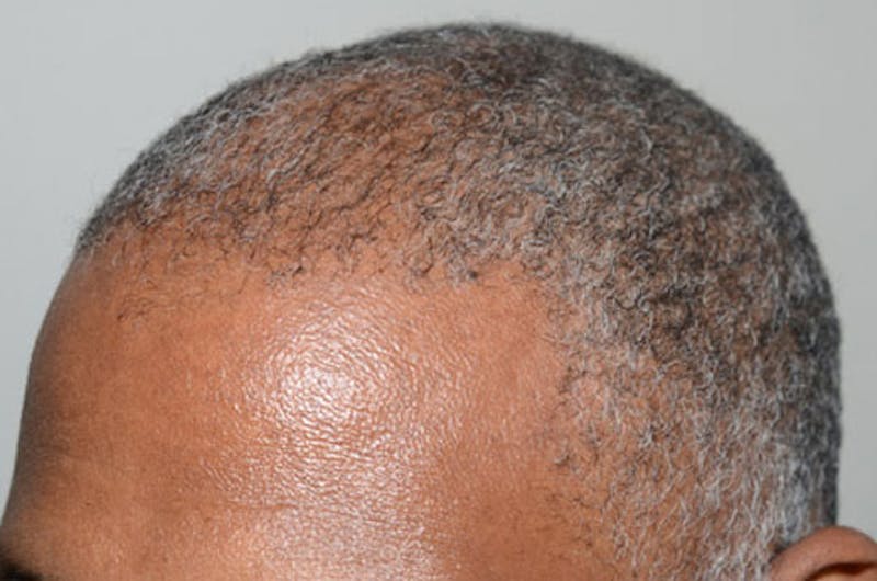 Hair Restoration for Men Before & After Gallery - Patient 309940 - Image 4