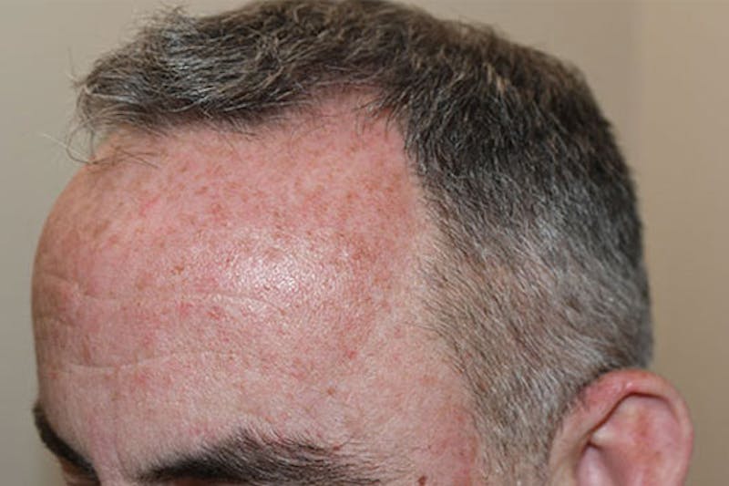 Hair Restoration for Men Before & After Gallery - Patient 108626 - Image 1