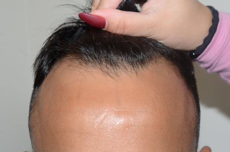 Hair Restoration for Men Before & After Gallery - Patient 319044 - Image 1