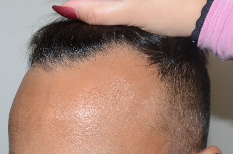 Hair Restoration for Men Before & After Gallery - Patient 319044 - Image 3