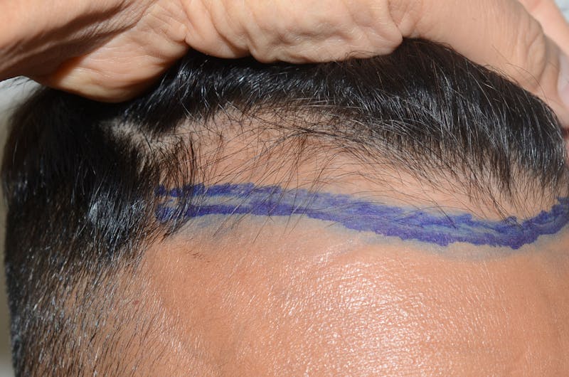 Hair Restoration for Men Before & After Gallery - Patient 319044 - Image 5
