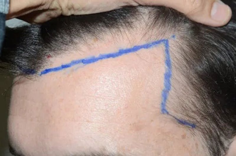 Hair Restoration for Men Before & After Gallery - Patient 262205 - Image 3