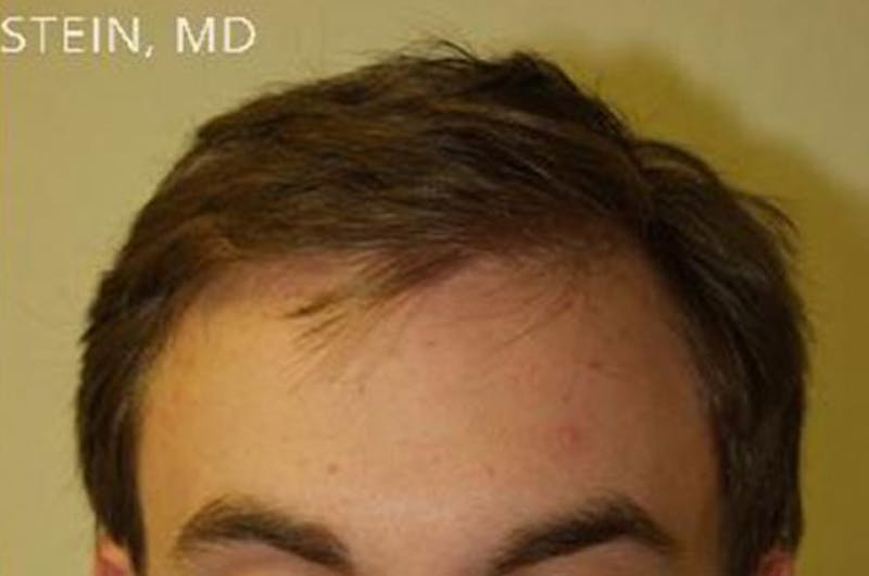 Hair Restoration for Men Before & After Gallery - Patient 320488 - Image 2