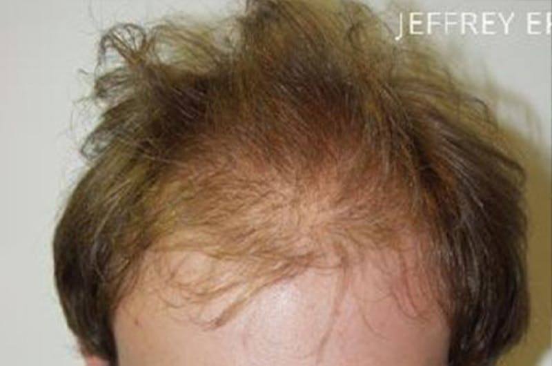Hair Restoration for Men Before & After Gallery - Patient 320488 - Image 1
