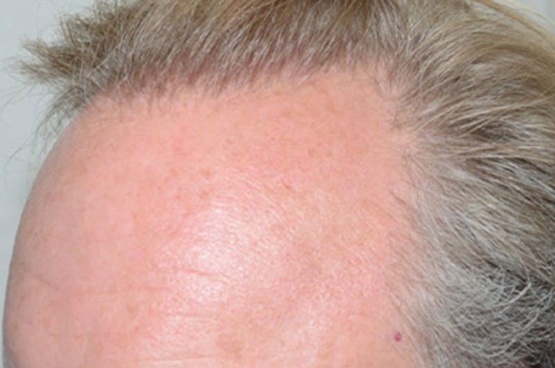 Hair Restoration for Men Before & After Gallery - Patient 393068 - Image 2
