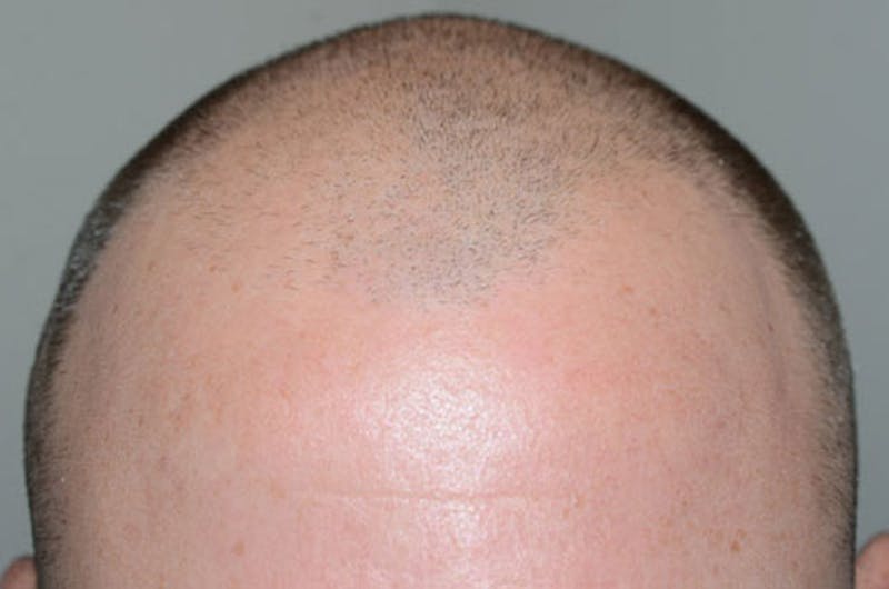 Hair Restoration for Men Before & After Gallery - Patient 162123 - Image 3