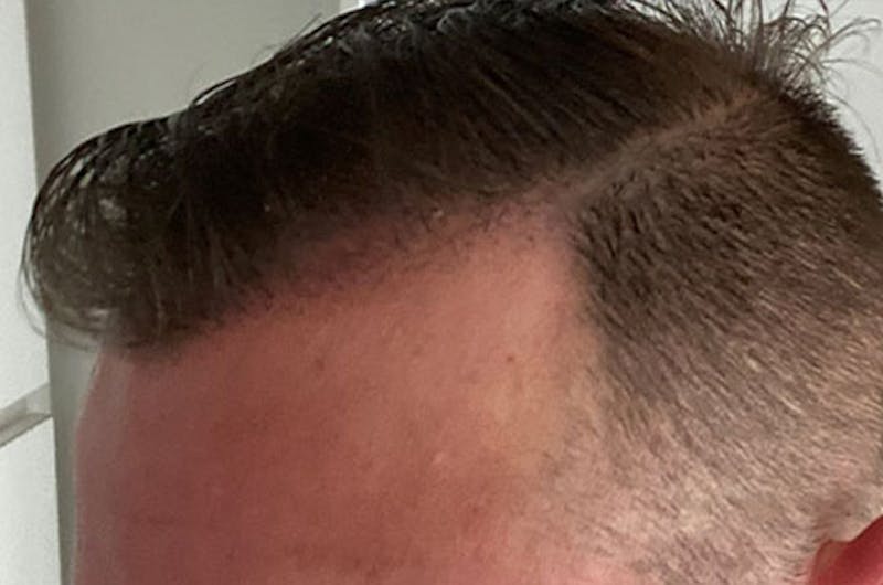 Hair Restoration for Men Before & After Gallery - Patient 162123 - Image 6