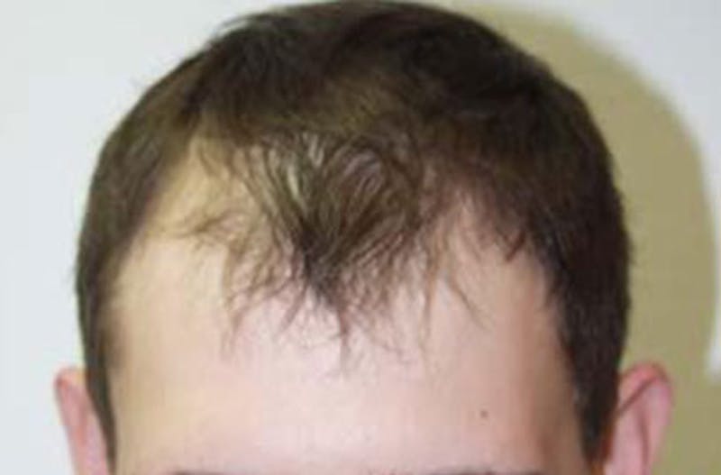 Hair Restoration for Men Before & After Gallery - Patient 307330 - Image 1