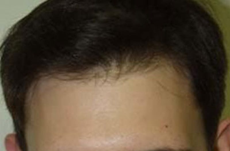 Hair Restoration for Men Before & After Gallery - Patient 307330 - Image 2