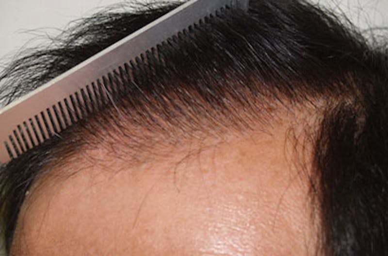 Hair Restoration for Men Before & After Gallery - Patient 290342 - Image 6