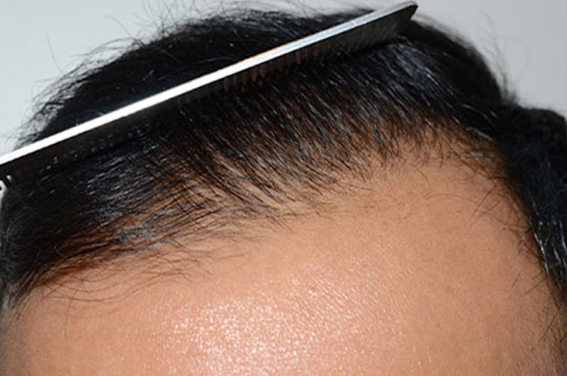 Hair Restoration for Men Before & After Gallery - Patient 365820 - Image 2