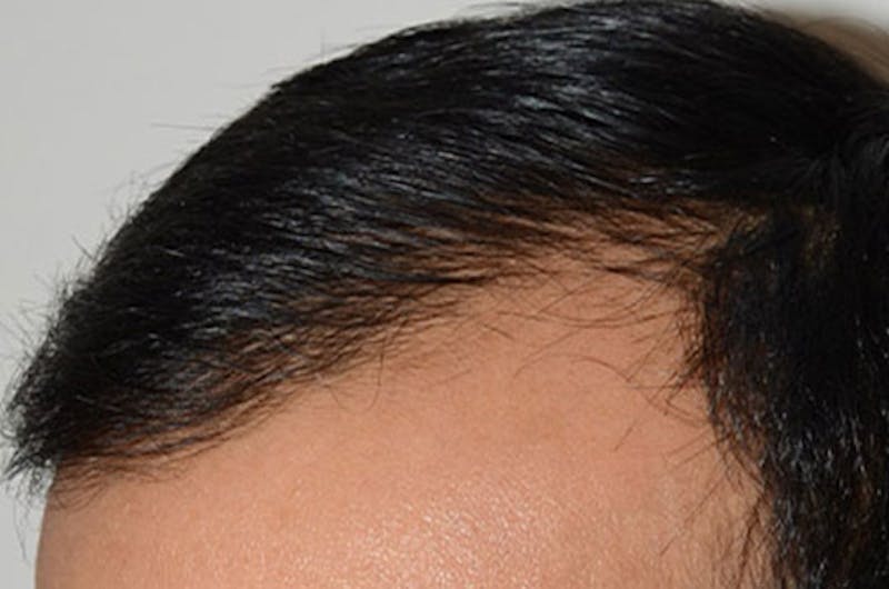 Hair Restoration for Men Before & After Gallery - Patient 365820 - Image 4