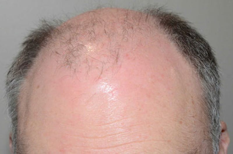 Hair Restoration for Men Before & After Gallery - Patient 166453 - Image 1