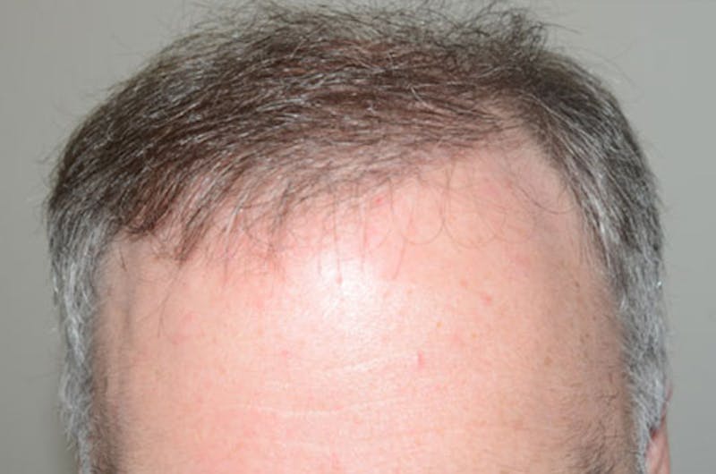 Hair Restoration for Men Before & After Gallery - Patient 166453 - Image 2