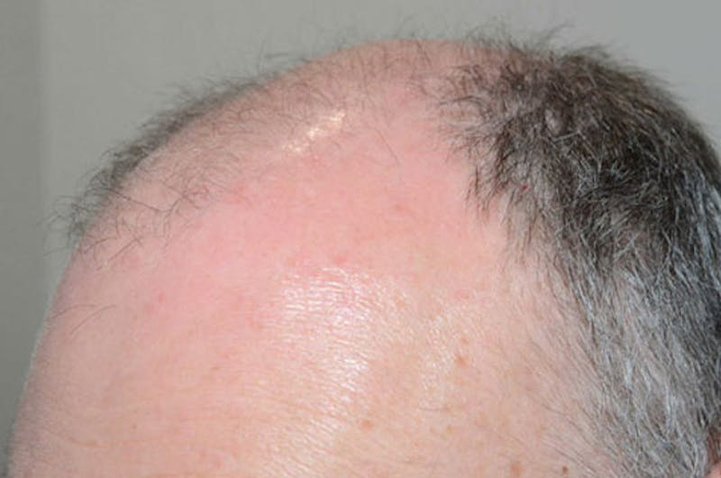 Hair Restoration for Men Before & After Gallery - Patient 166453 - Image 3