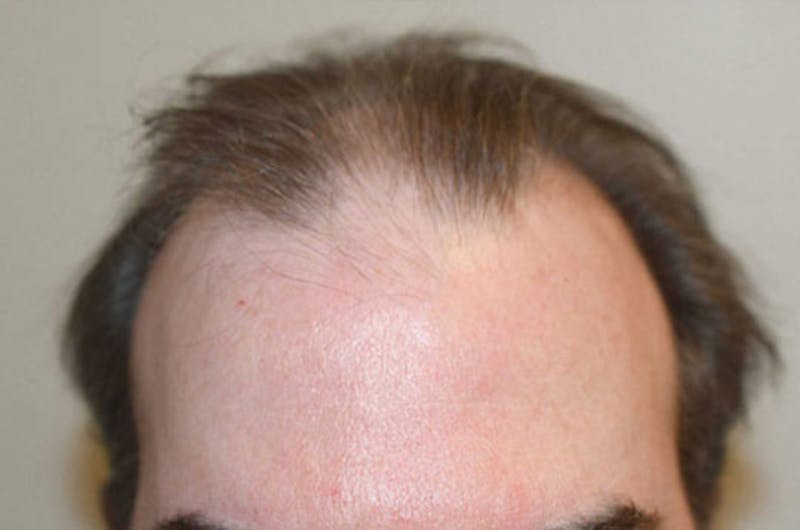 Hair Restoration for Men Before & After Gallery - Patient 152094 - Image 1
