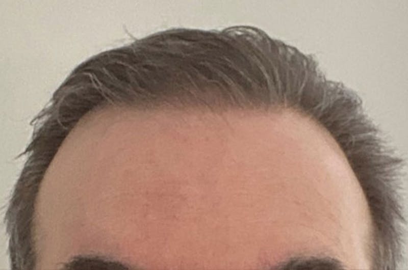 Hair Restoration for Men Before & After Gallery - Patient 152094 - Image 2