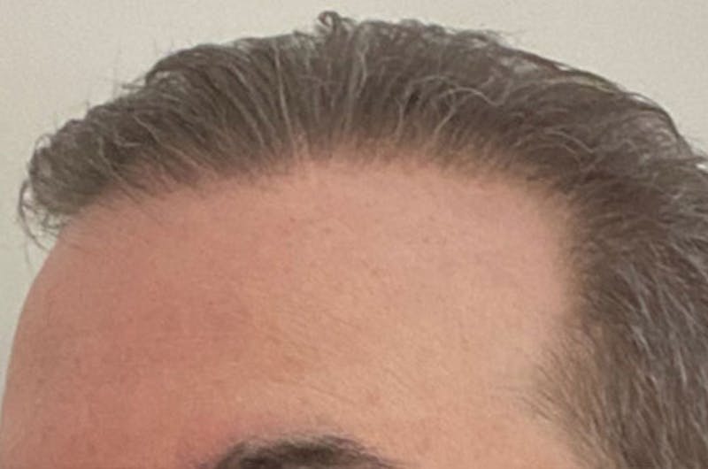 Hair Restoration for Men Before & After Gallery - Patient 152094 - Image 4