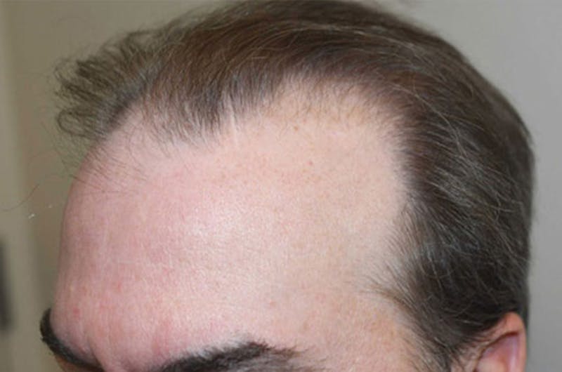 Hair Restoration for Men Before & After Gallery - Patient 152094 - Image 3