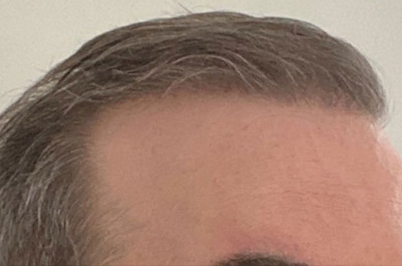 Hair Restoration for Men Before & After Gallery - Patient 152094 - Image 6