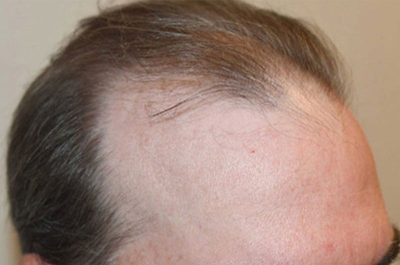 Hair Restoration for Men Before & After Gallery - Patient 152094 - Image 5