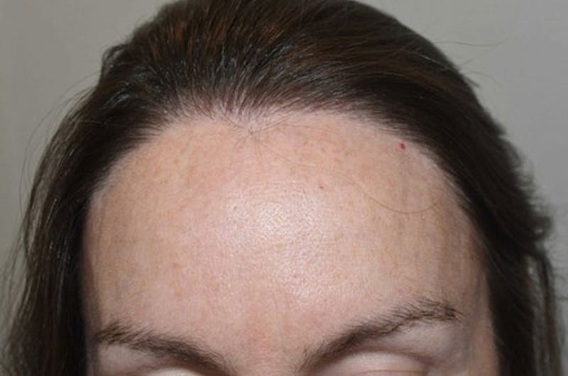 Hair Procedures for Women Before & After Gallery - Patient 115723 - Image 2