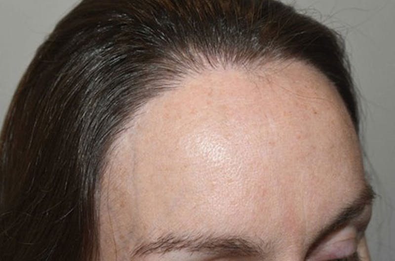 Hair Procedures for Women Before & After Gallery - Patient 115723 - Image 6