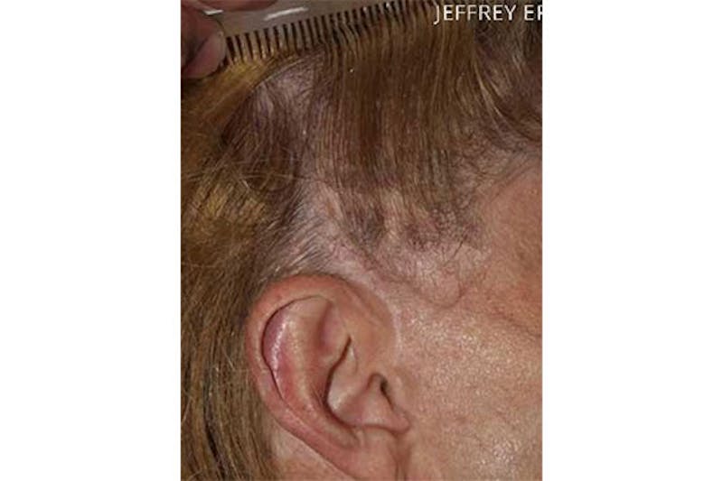 Hair Procedures for Women Before & After Gallery - Patient 193928 - Image 1