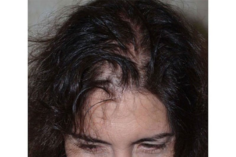 Hair Procedures for Women Before & After Gallery - Patient 172669 - Image 1