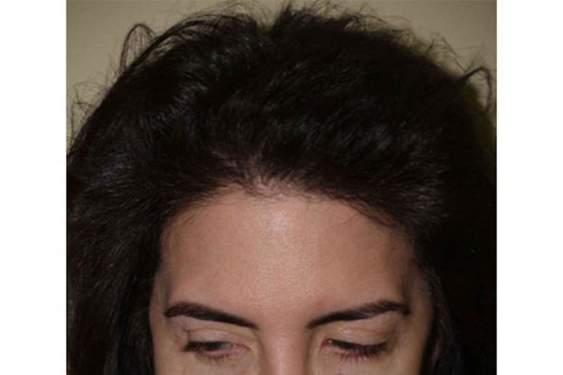 Hair Procedures for Women Before & After Gallery - Patient 172669 - Image 2