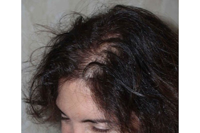 Hair Procedures for Women Before & After Gallery - Patient 172669 - Image 3
