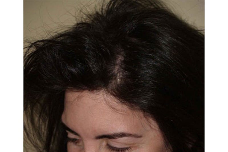 Hair Procedures for Women Before & After Gallery - Patient 172669 - Image 4