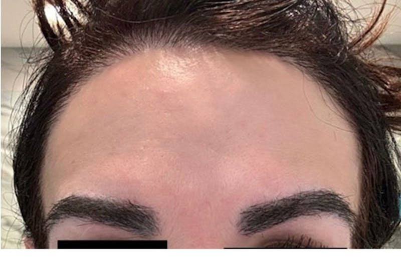 Hair Procedures for Women Before & After Gallery - Patient 179677 - Image 2