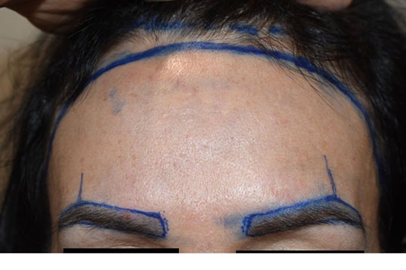 Hair Procedures for Women Before & After Gallery - Patient 179677 - Image 1