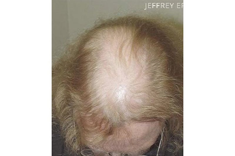 Hair Procedures for Women Before & After Gallery - Patient 263341 - Image 1