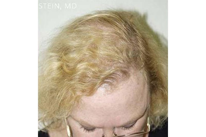 Hair Procedures for Women Before & After Gallery - Patient 263341 - Image 2