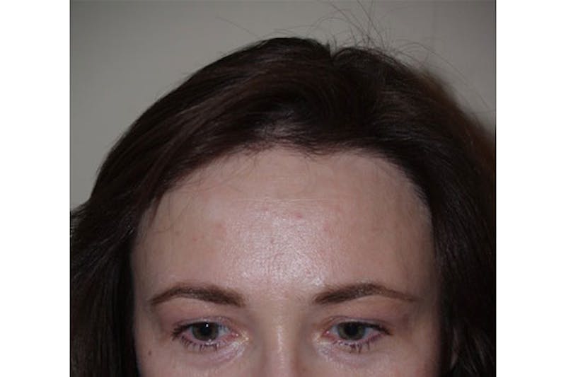 Hair Procedures for Women Before & After Gallery - Patient 271481 - Image 1