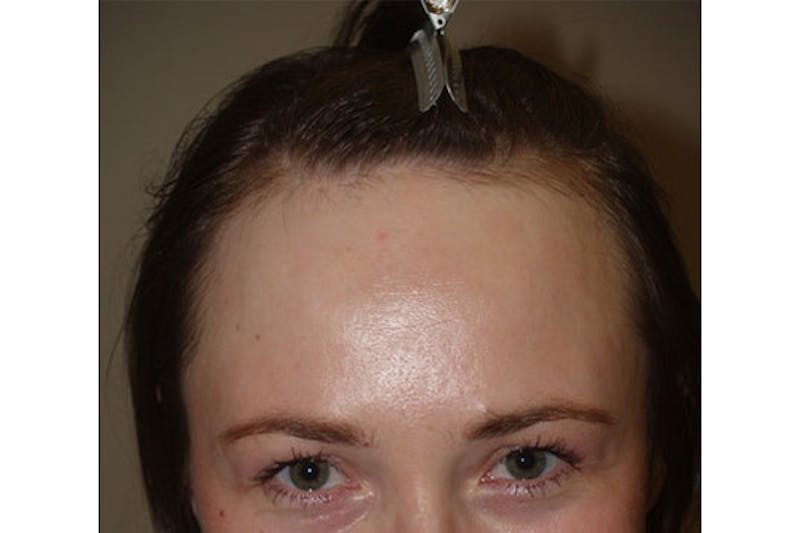 Hair Procedures for Women Before & After Gallery - Patient 271481 - Image 2