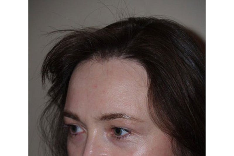 Hair Procedures for Women Before & After Gallery - Patient 271481 - Image 3