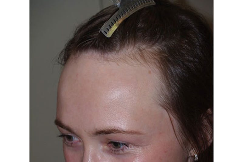 Hair Procedures for Women Before & After Gallery - Patient 271481 - Image 4