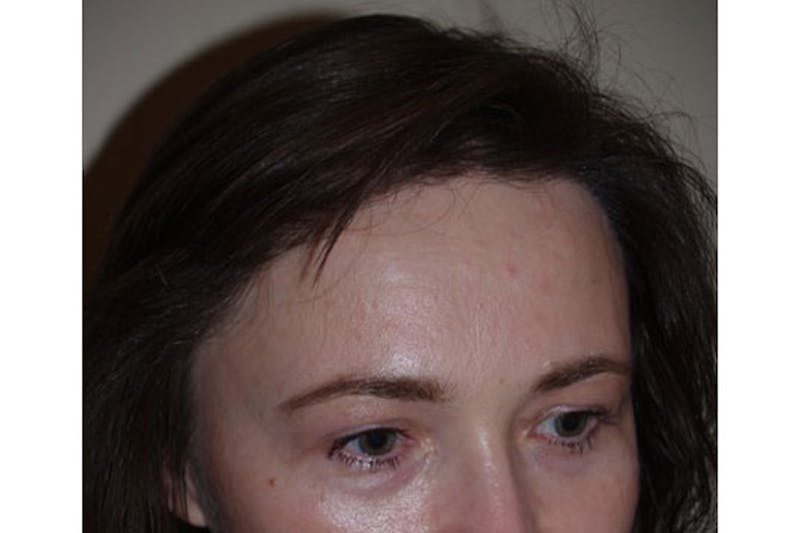 Hair Procedures for Women Before & After Gallery - Patient 271481 - Image 6