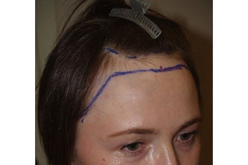 Hair Procedures for Women Before & After Gallery - Patient 271481 - Image 5