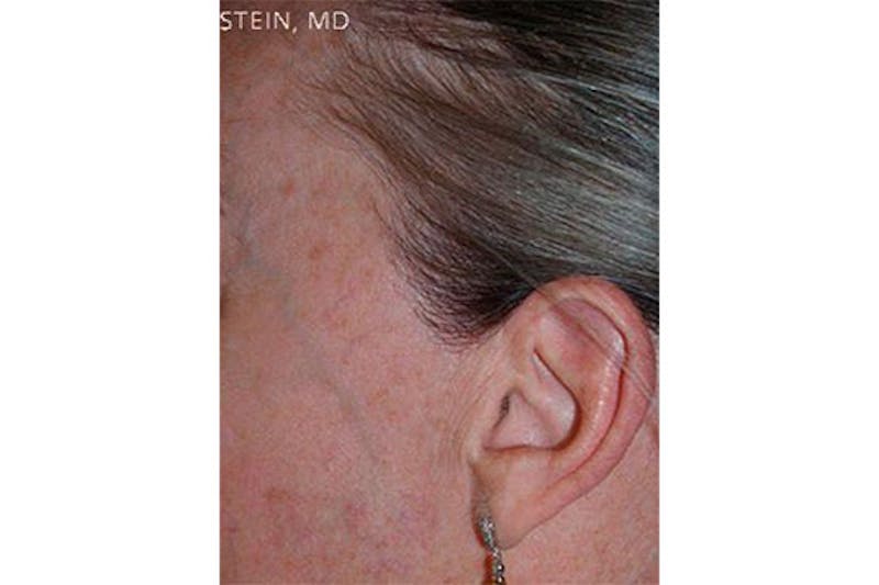 Hair Procedures for Women Before & After Gallery - Patient 282699 - Image 2