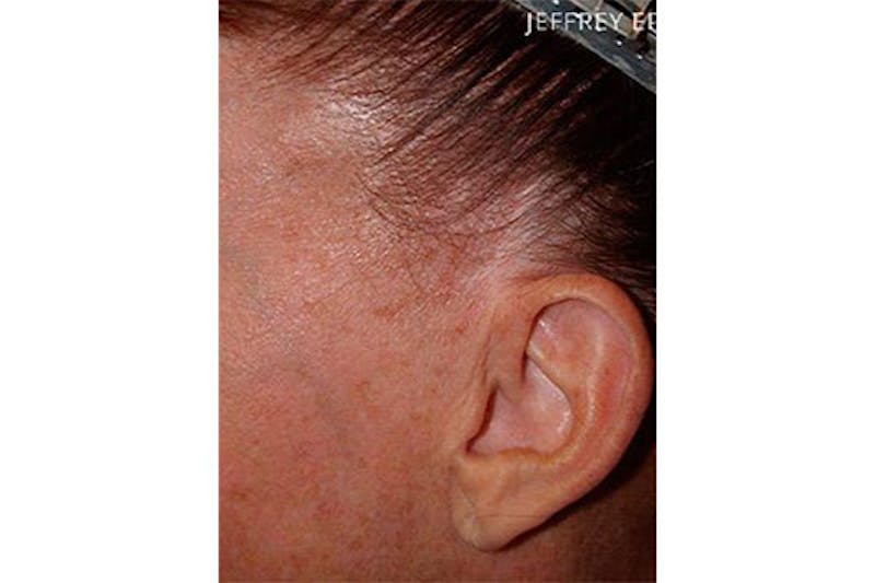 Hair Procedures for Women Before & After Gallery - Patient 282699 - Image 1