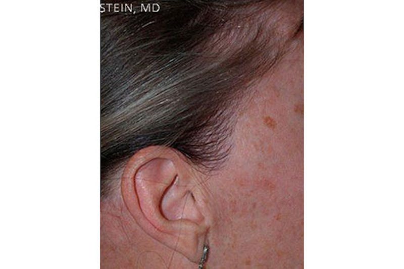 Hair Procedures for Women Before & After Gallery - Patient 282699 - Image 4