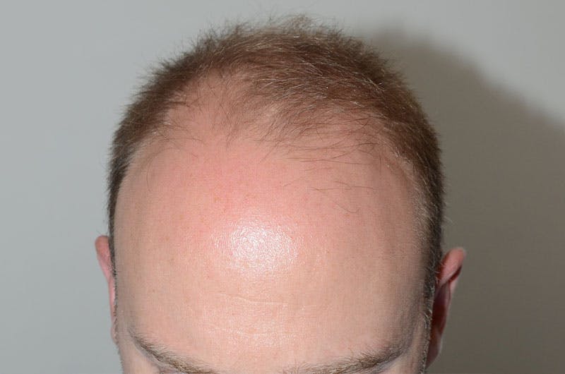 Hair Restoration for Men Before & After Gallery - Patient 305730 - Image 1