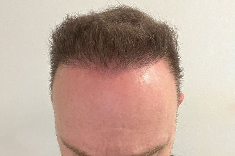 Hair Restoration for Men Before & After Gallery - Patient 305730 - Image 2