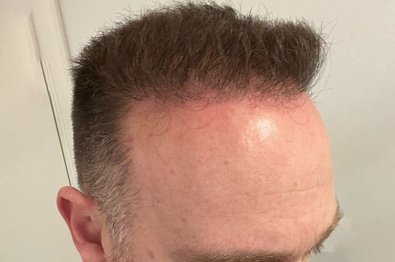 Hair Restoration for Men Before & After Gallery - Patient 305730 - Image 4