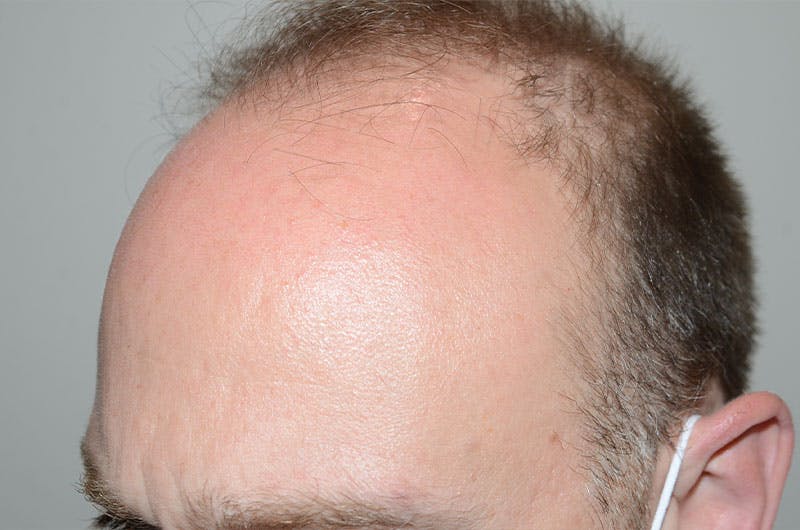 Hair Restoration for Men Before & After Gallery - Patient 305730 - Image 5