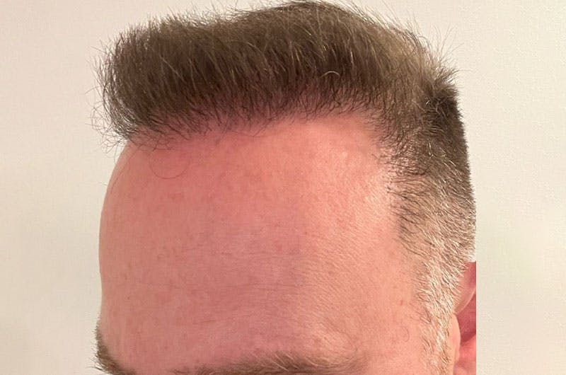 Hair Restoration for Men Before & After Gallery - Patient 305730 - Image 6